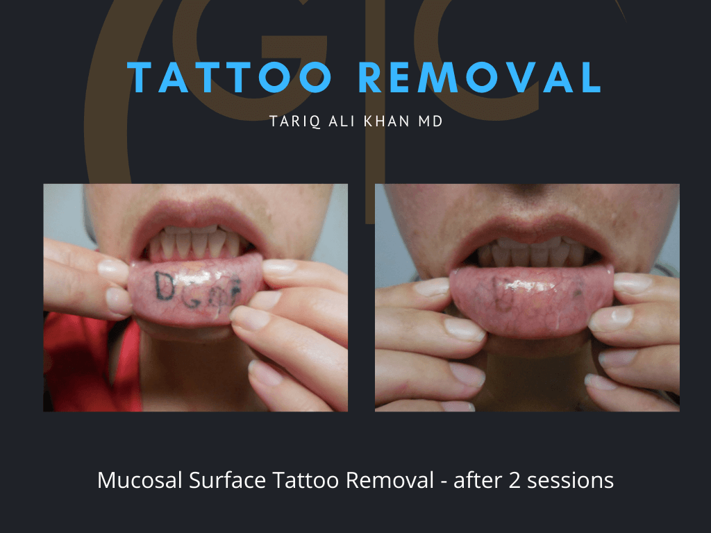 Gentle Care Laser Tustin Before and After picture - Tattoo Removal Mucosal Surface